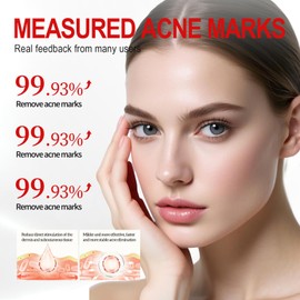 25g Anti-Unreinheiten Gel für das Gesicht, Anti Pickel Gel, Ölkontrolle und Feuchtigkeitsversorgung, Hellt Akneflecken und Pickel Auf,Geeignet für Männer und Frauen