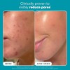Exfoliante Facial Con Ácido Salicílico Para Poros Dilatados