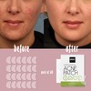 GREIGHT BRAND PRODUCTS pimple patches for face - (60 Count)