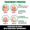 JAYSUING Ginger Nail Treatment-Vitamin E & Plant Extracts for Repairing