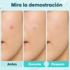 Parches Para Acné Hidrocoloide 360pcs,absorbe La Grasa