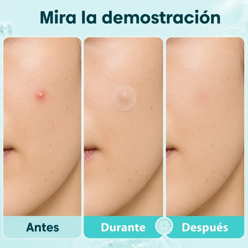Parches Para Acné Hidrocoloide 360pcs,absorbe La Grasa
