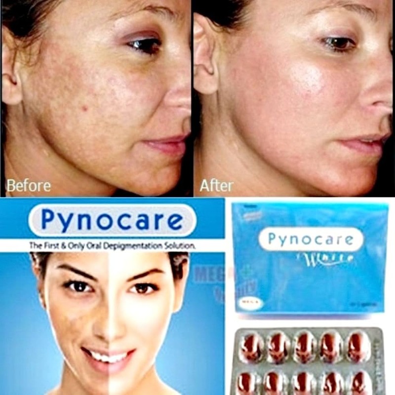 Nakarad Pynocare White Treatment of Melasma 20 Capsules