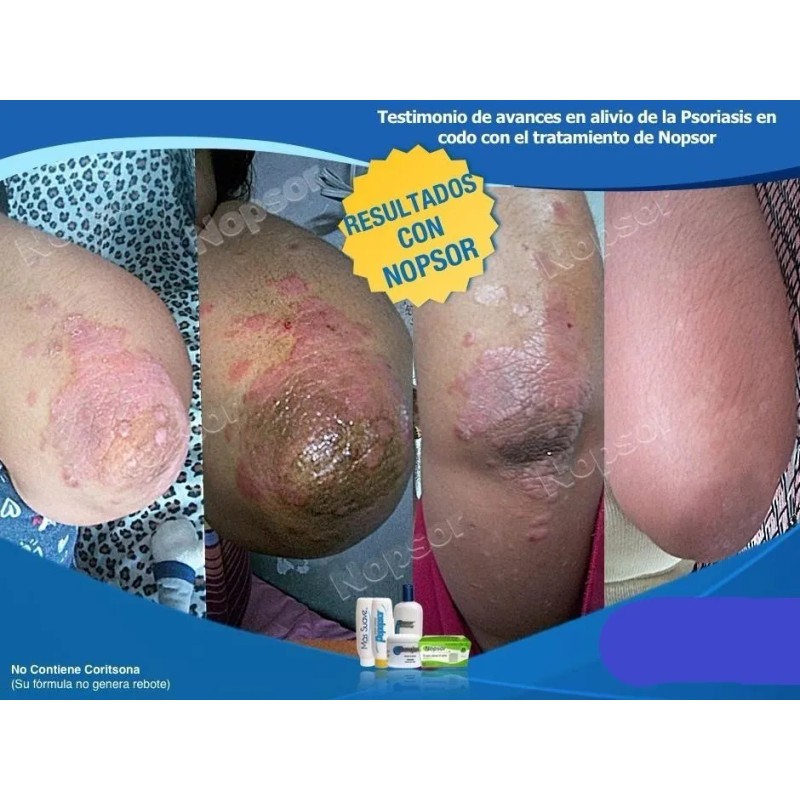 500gr Crema Mas Suave, Pomada Nopsor 125gr Aux. Tx Psoriasis