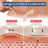 Silicone Scar Sheets (1.6” x 120” Roll-3M), Silicone Scar Tape