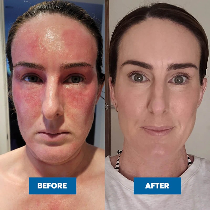 MooGoo Eczema & Psoriasis Cream, 120g