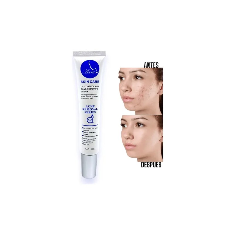 Crema Anti Acné Elimina Granos Espinillas Tratamiento 30g
