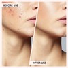 FEITA Blackhead Remover Pimple Comedone Extractor Tool, Stainless Acne Tools