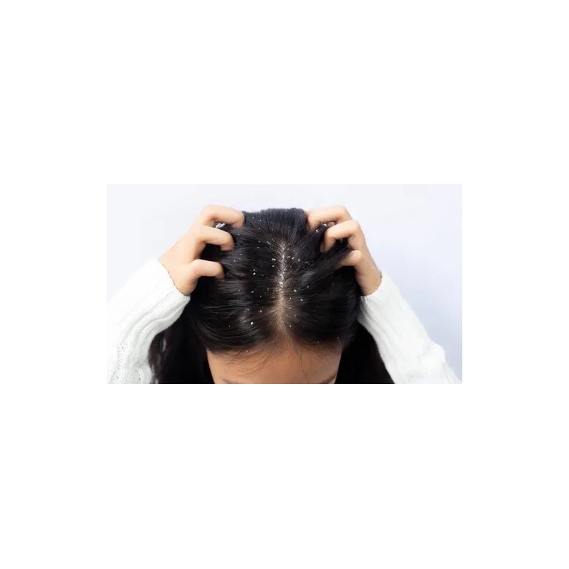 Shampoo Adiós Caspa, Comezón Y Resequedad Shelo Nabel 530ml