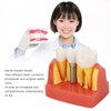 Dental Implant Teeth Model, Dental Implant Analysis Crown Bridge Model,