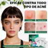 Lunixila Microagujas Para Parches Antiacné,conjunto De 3 En1