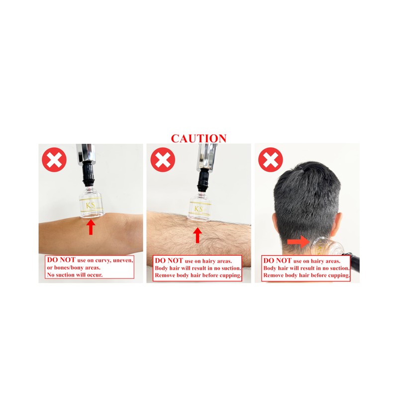 KS AG Professional Cupping Set (17 Cups) with Extension Tube