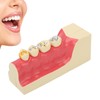Right Lower Posterior Tooth Model 2X Magnification Detachable Resin Tooth