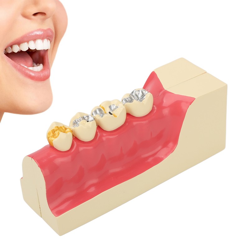 Right Lower Posterior Tooth Model 2X Magnification Detachable Resin Tooth