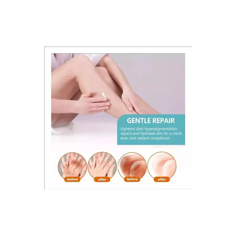 Crema Para Acantosis Nigricans Fbgx2