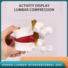 Human Anatomical Lumbar Disc Herniation Model, 1.5X Life-Size Herniated Lumbar