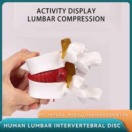 Human Anatomical Lumbar Disc Herniation Model, 1.5X Life-Size Herniated Lumbar Vertebrae Spine Model for Medical Teaching, Patient Education, Classroom Learning & Demonstration