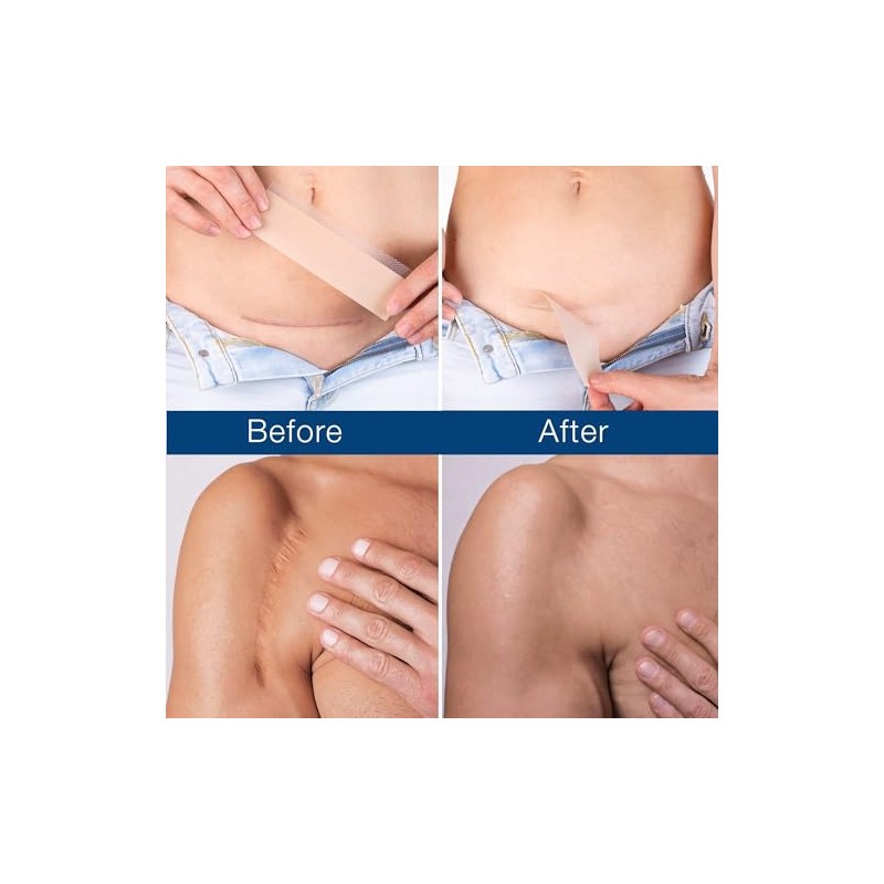 Admirada Silicone Sheets for Scars: Reusable Scar Care Tape for