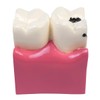 Sarini Tooth Model, Caries Comparative Study Model,Dentist Dental Anatomy Educational