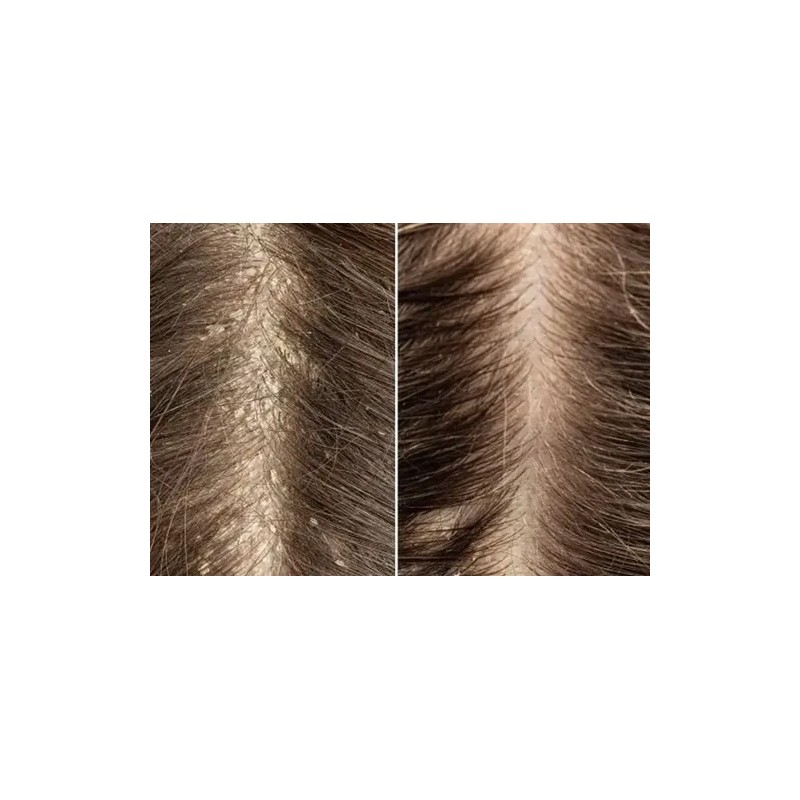 Shampoo Adiós Caspa Sheló Elimina Resequedad Restaura Cabell