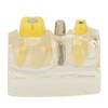 Teeth Implant Model Transparent Dental Teaching Research Demonstration Teeth Model