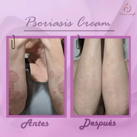 Psoriasis Cream, Facial Corporal Psoriasis Aliviante. Neutra