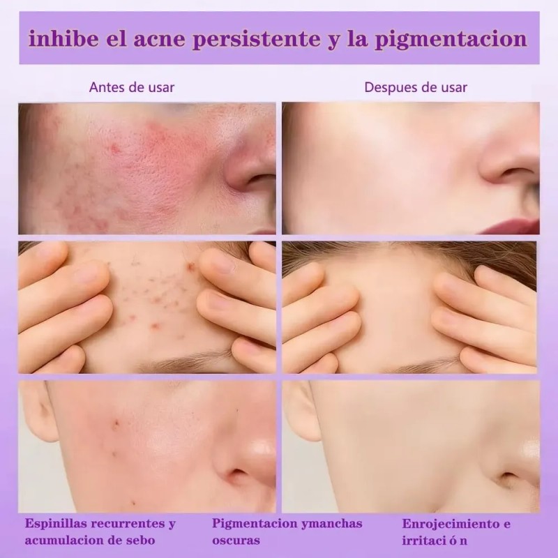 Crema Facial Con Ácido Azelaico Al 15%, Sérum Con Vitamina
