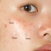 Epielle Over-Zit Acne Clear Patches 138 Count, Hydrocolloid Acne Pimple