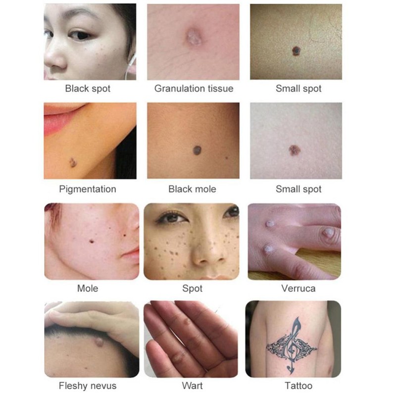 Ultrasonic Freckle Spots Removal Machine Detoxifying Face Care Machine for