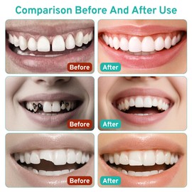 Tooth Repair Kit with 4 Dental Tools, Temporary Tooth Replacement Set, Moldable Dental Fix