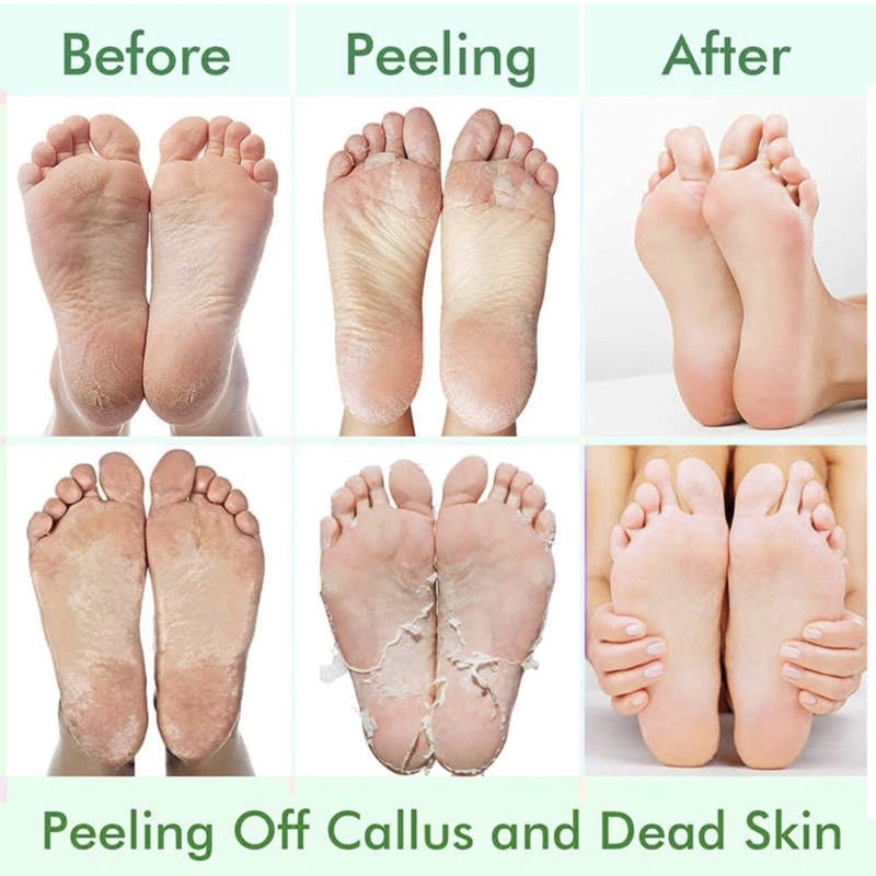Paquete de 5 mascarillas exfoliantes de pies, exfoliante pelar callosidades
