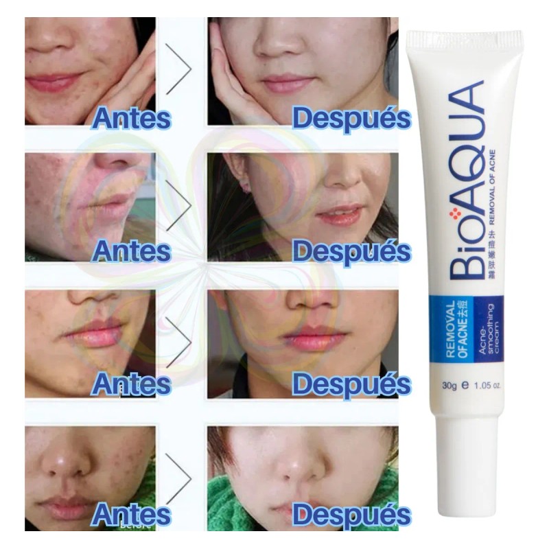 Crema Cicatrices Poros Control De Grasa Acne Cream 2pz Full
