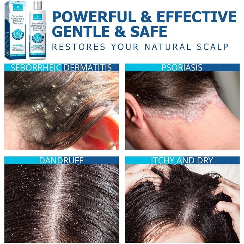 Roycederm Champú para la psoriasis, dermatitis seborreica, foliculitis y caspa,