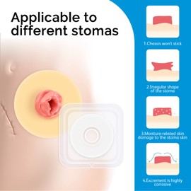 Ostomy Barrier Rings, 10 Pieces Ostomy Leak-Proof Ring Strips for Ostomy Bags Compatible with All Bag Types and Brands, Ostomy Bag, Outer Diameter: 4 mm Thickness (Box of 10)