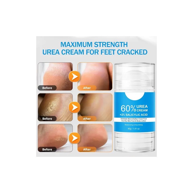 Crema De Urea De Máxima Potencia Para Pies, 2 Unidades