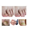 Líquido Para Hongos En Uñas - Cura Hongos Y Onicomicosis