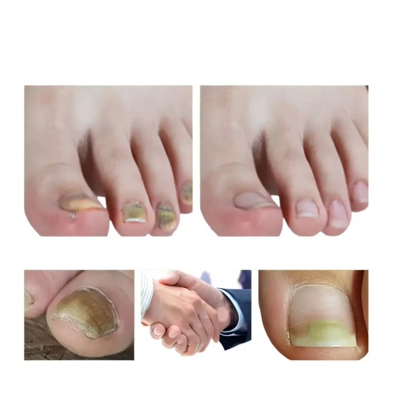 Líquido Para Hongos En Uñas - Cura Hongos Y Onicomicosis