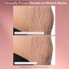 StriVectin SD Advanced PLUS Intensive Humectante ataca la pérdida de