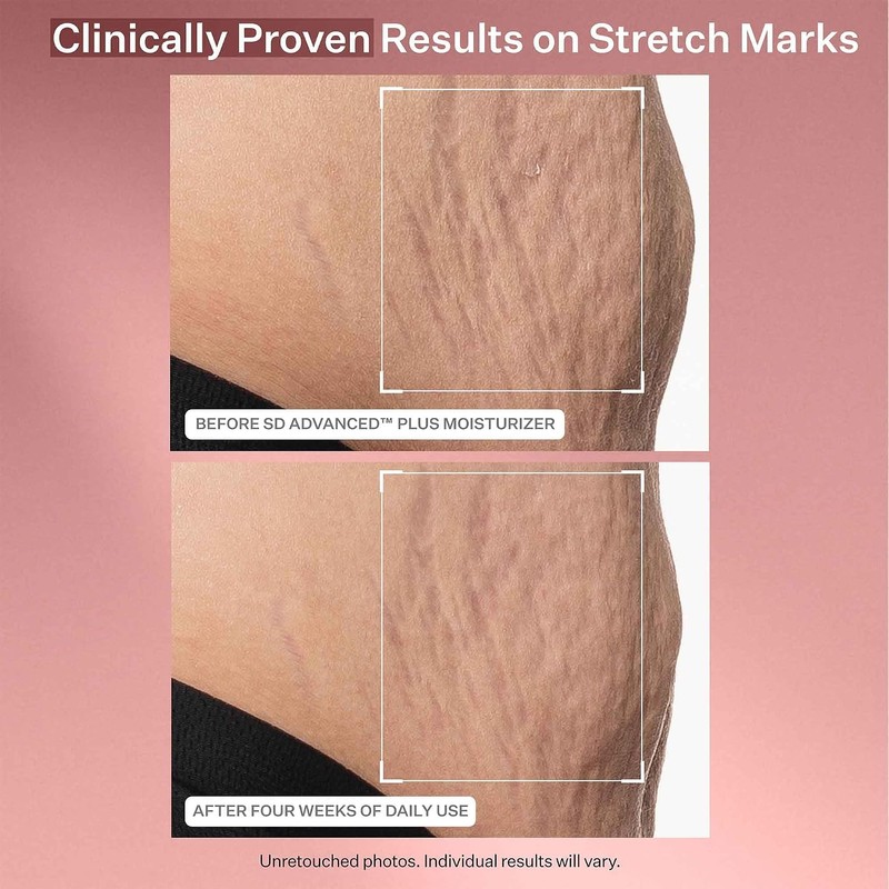 StriVectin SD Advanced PLUS Intensive Humectante ataca la pérdida de