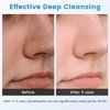 Lrbsule Pore Cleaner – Blackhead & Pimple Remover with 6