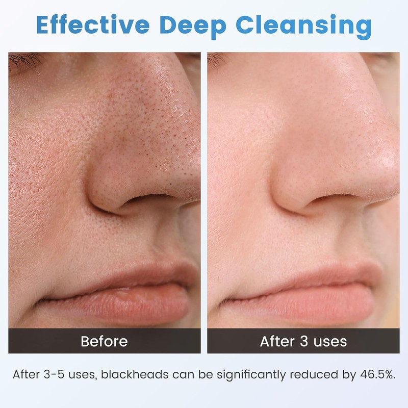 Lrbsule Pore Cleaner – Blackhead & Pimple Remover with 6