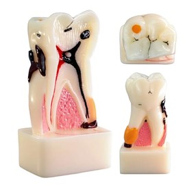 MediTrainer Teeth Model,4X Periodontal Disease Tooth Model, Caries Model, Tooth Decay Model, Tooth Anatomy Model, for Doctor-Patient Communication and Research Teaching