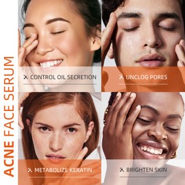 Salicylic Acid Serum for Acne, 1.1fl.oz/30ml Acne Serum with Vitamin B6, Lactic Acid, AHA, BHA, Zinc PCA, Skin Care Essence for Blackhead, Sebum, Pore