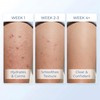 Butt & Thigh Acne Cream – Fast Acting Exfoliating Body