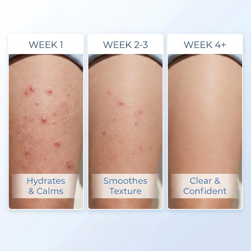 Butt & Thigh Acne Cream – Fast Acting Exfoliating Body