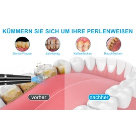 Zahnreinigung Set, HOFENY Zahnstein-Entfernen mensch mit 5 Modi für Zahnstein- und Fleckenentfernung, mit LED-Licht für Zahnreinigung