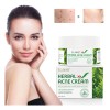 Crema Herbal Antiacné Control Grasa, Granos Espinillas 2 Pzs Acneica