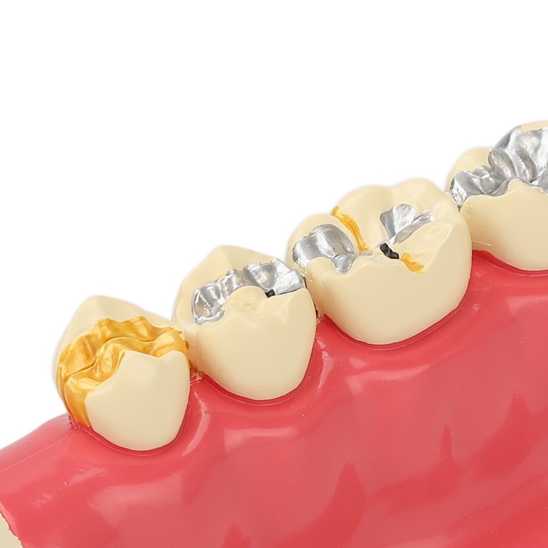Right Lower Posterior Tooth Model 2X Magnification Detachable Resin Tooth