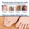 Ingrown Toenails Tool Set, Patch Stickers, Toenail Corrector, Pedicure Tools,