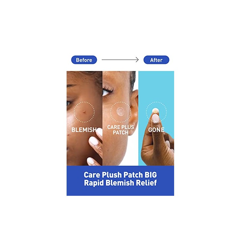 Hydrocolloid Acne Spot Patch - Clear Zits & Blemishes